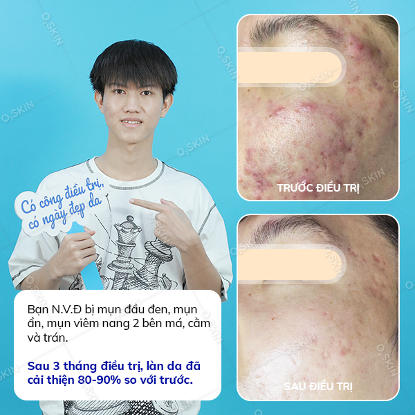 Kết quả trị mụn của khách hàng Nguyễn Văn Định tại phòng khám da liễu O2 SKIN