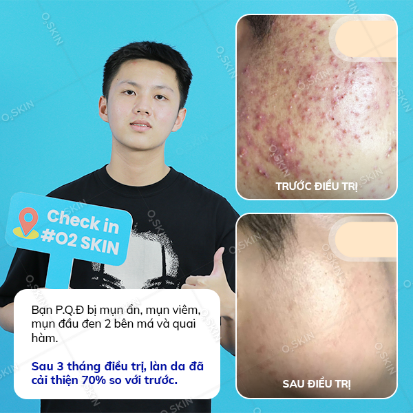 Kết quả trị mụn của khách hàng Phạm Quốc Đạt tại phòng khám da liễu O2 SKIN