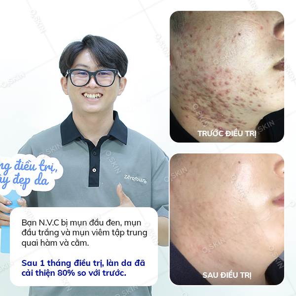 Kết quả trị mụn của khách hàng Nguyễn Văn Chí tại phòng khám da liễu O2 SKIN