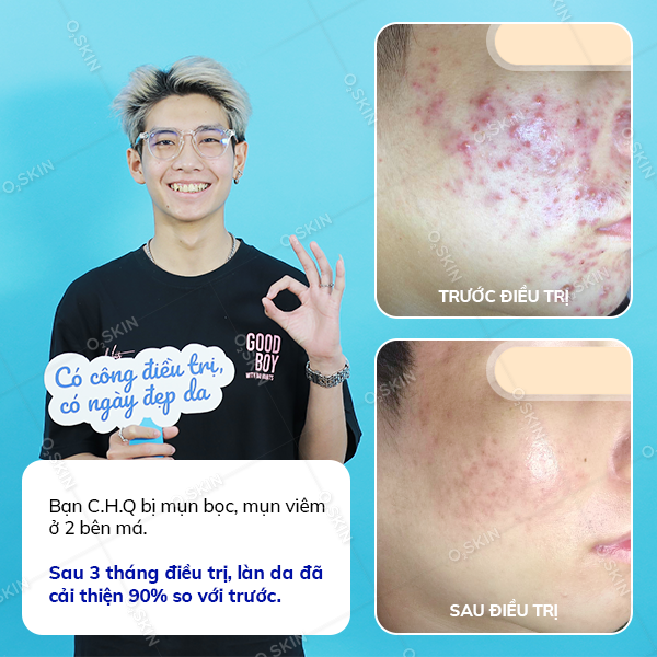 Kết quả trị mụn của khách hàng Cao Hùng Quân tại phòng khám da liễu O2 SKIN