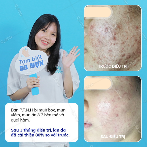 Kết quả trị mụn của khách hàng Phạm Thị Ngọc Huyền tại phòng khám da liễu O2 SKIN