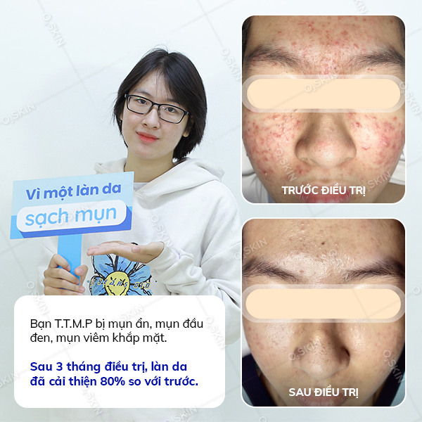 Kết quả trị mụn của khách hàng Trình Thị Minh Phương tại phòng khám da liễu O2 SKIN