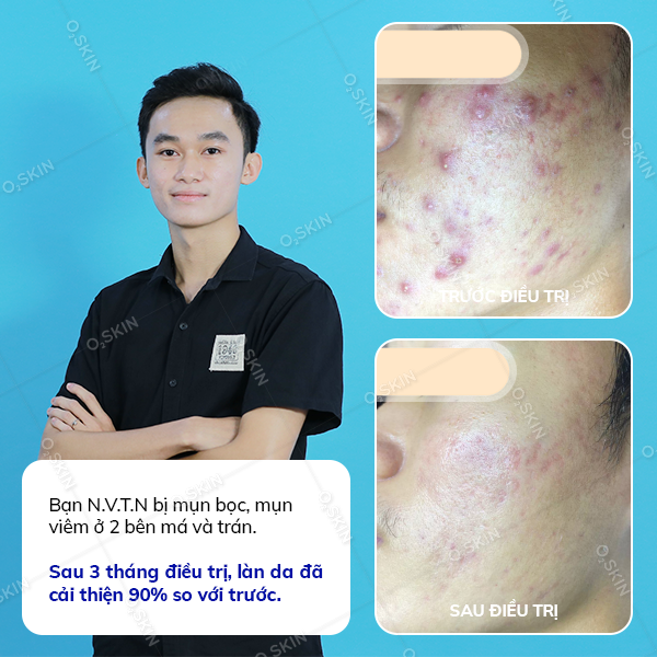 Kết quả trị mụn của khách hàng Nguyễn Võ Trọng Nhân tại phòng khám da liễu O2 SKIN