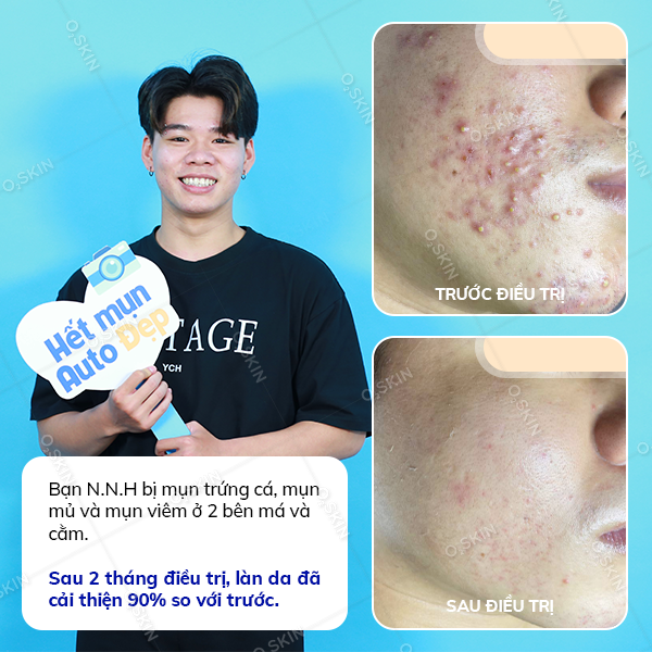 Kết quả trị mụn của khách hàng Nguyễn Nhật Hưng tại phòng khám da liễu O2 SKIN