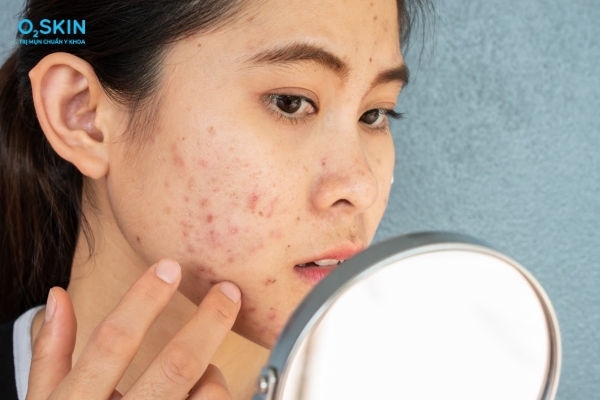 14 cách trị mụn trứng cá ở tuổi dậy thì tại nhà đơn giản