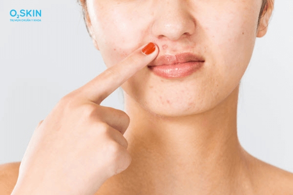 Nguyên nhân gây mụn trứng cá