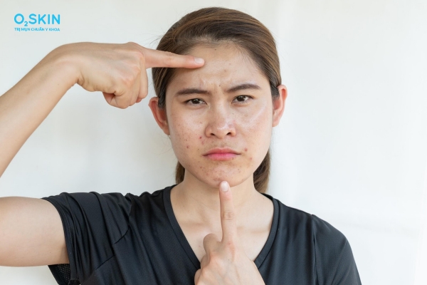 Điều trị mụn trứng cá trong bao lâu