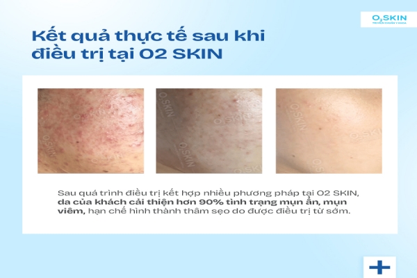 Trị mụn chuẩn y khoa tại O2SKIN