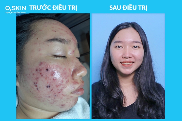 Lưu ý khi dùng kháng sinh điều trị mụn trứng cá