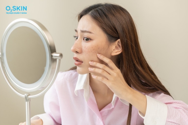 Mụn trứng cá có tự khỏi không