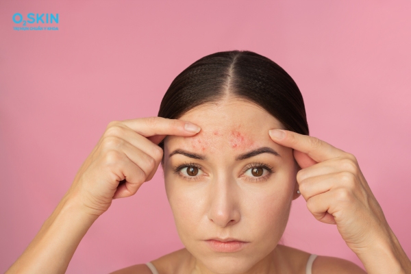 Mụn trứng cá ở trán