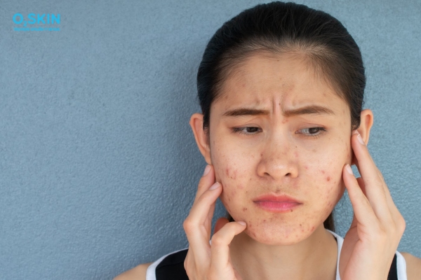 Mụn trứng cá tuổi dậy thì kéo dài bao lâu