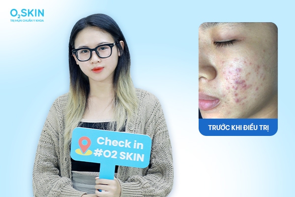 Mặt tự nhiên nổi nhiều mụn trứng cá trị ở đâu