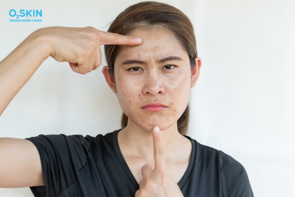 Nguyên nhân gây mụn trứng cá phổ biến