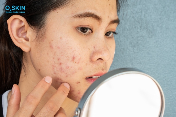 Nguyên nhân mụn trứng cá