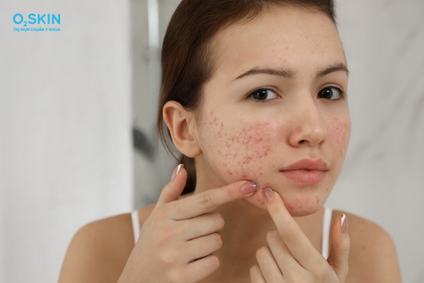 Nguyên nhân gây ra mụn trứng cá