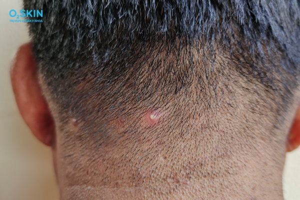 Mụn trứng cá trên da đầu do đâu