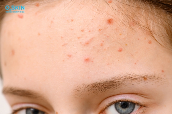 Các loại mụn trứng cá trên trán