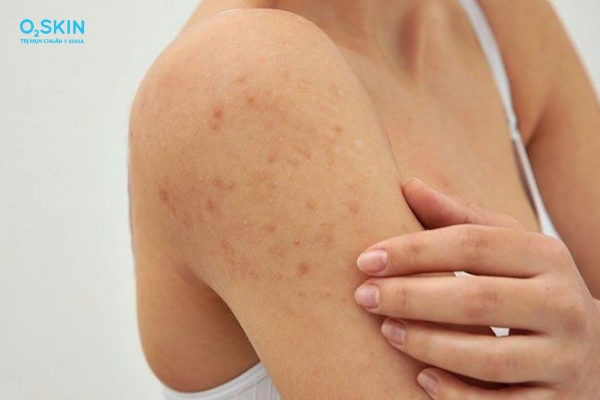 Phân biệt mụn trứng cá ở tay