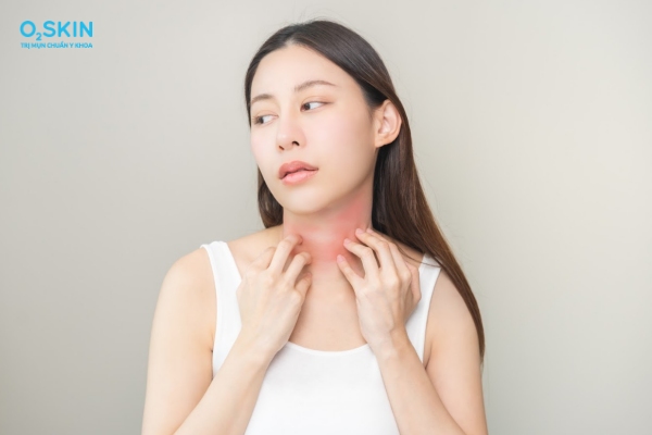 Bị mụn trứng cá ở cổ do đâu