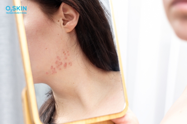 Bị mụn trứng cá ở cổ do bệnh lý