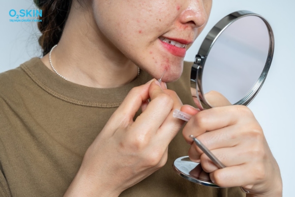 Vì sao không nên nặn mụn trứng cá