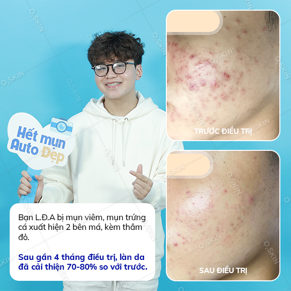 Hiệu quả trị mụn của khách hàng Le Duc Anh (nam) sau khi đến phòng khám da liễu O2 SKIN