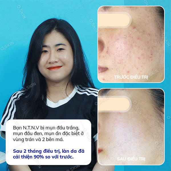 Hiệu quả trị mụn của khách hàng Nguyen Thi Ngoc Vy (nữ) sau khi đến phòng khám da liễu O2 SKIN