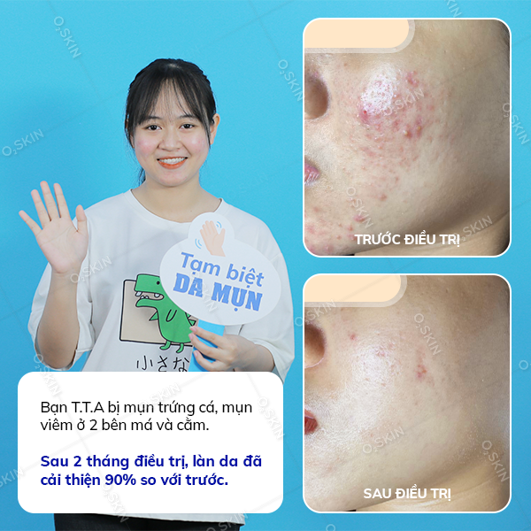 Hiệu quả trị mụn của khách hàng Tran Tu Anh (nữ) sau khi đến phòng khám da liễu O2 SKIN