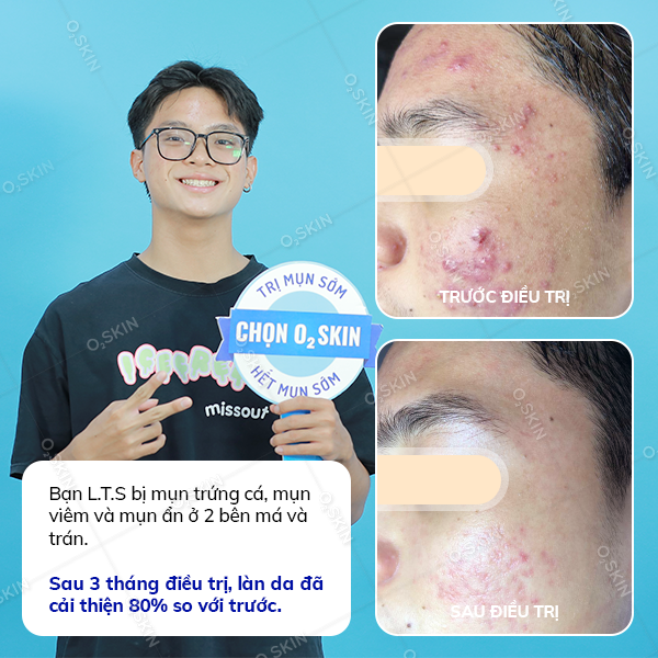 Hiệu quả trị mụn của khách hàng Le Thanh Son (nam) sau khi đến phòng khám da liễu O2 SKIN