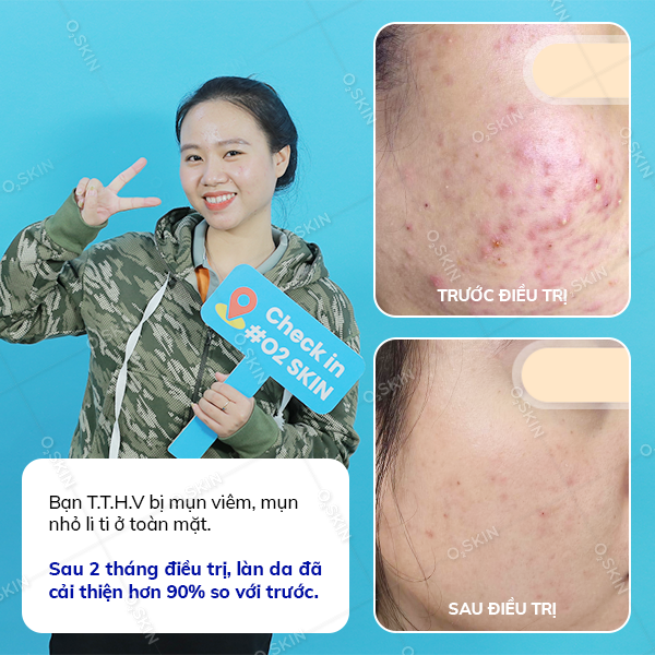 Hiệu quả trị mụn của khách hàng Tran Thi Hai Van (nữ) sau khi đến phòng khám da liễu O2 SKIN