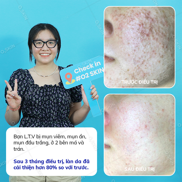 Hiệu quả trị mụn của khách hàng Ly Tuong Vy (nữ) sau khi đến phòng khám da liễu O2 SKIN