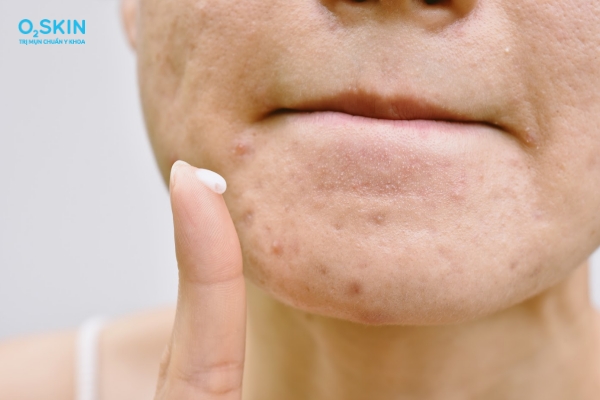 Cách dùng thuốc trị mụn bọc sưng đỏ