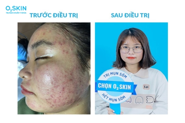 Mụn trứng cá gây tăng sắc tố sau viêm