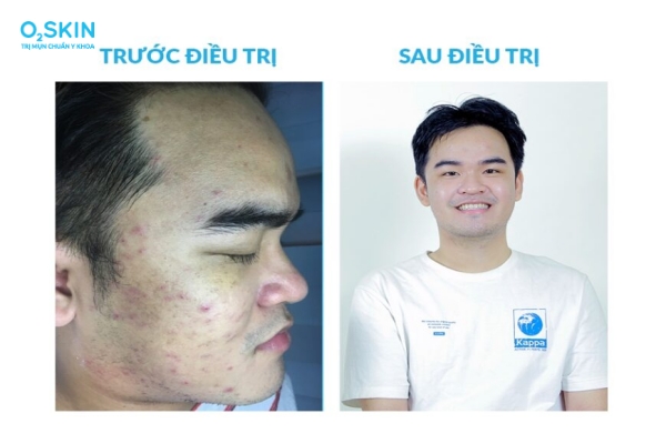 Sẹo mụn do hậu quả của mụn trứng cá