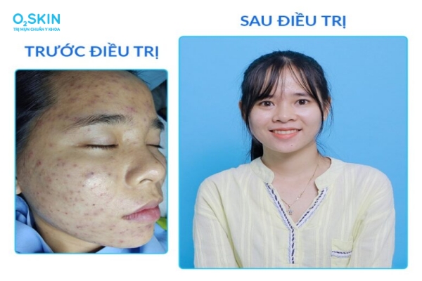 Mụn trứng cá làm giảm chất lượng cuộc sống