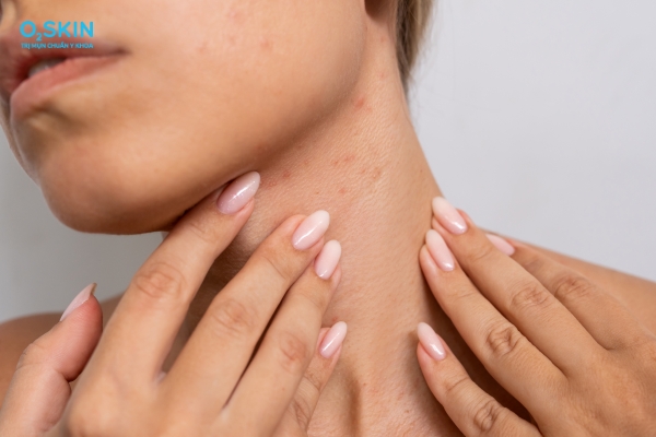 Chăm sóc da bị mụn bọc ở cổ