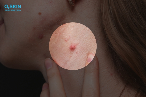 Nguyên nhân nổi mụn bọc ở cổ