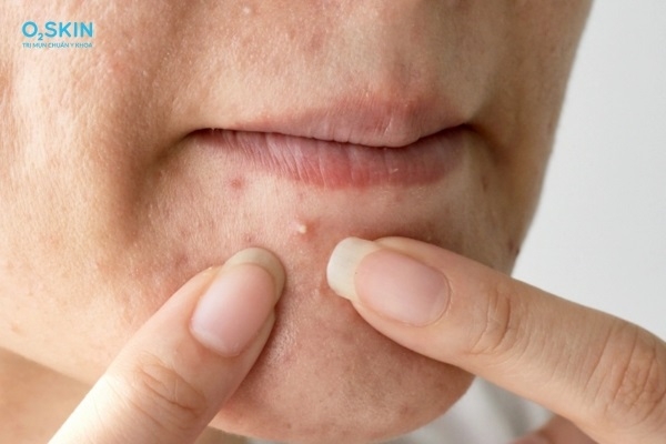 Vì sao da sần sùi mụn ẩn lỗ chân lông to