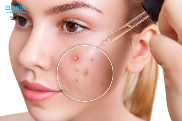 TOP 10 loại serum B5 cho da dầu mụn được yêu thích 2025