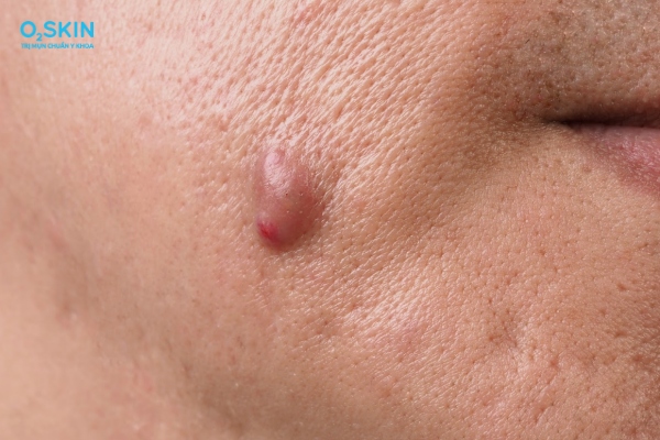 Mụn mủ áp xe có tự khỏi không