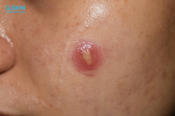 Mụn mủ đầu trắng có nên nặn không