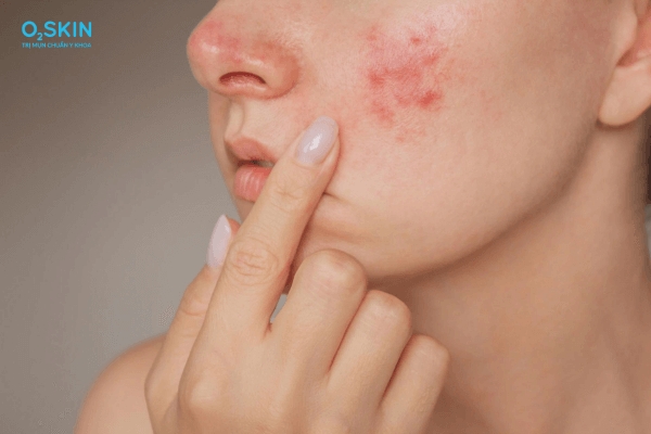 Vì sao da mặt đột nhiên nổi nhiều mụn