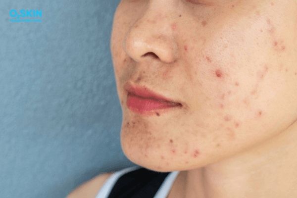 Vì sao nổi mụn dị ứng thời tiết