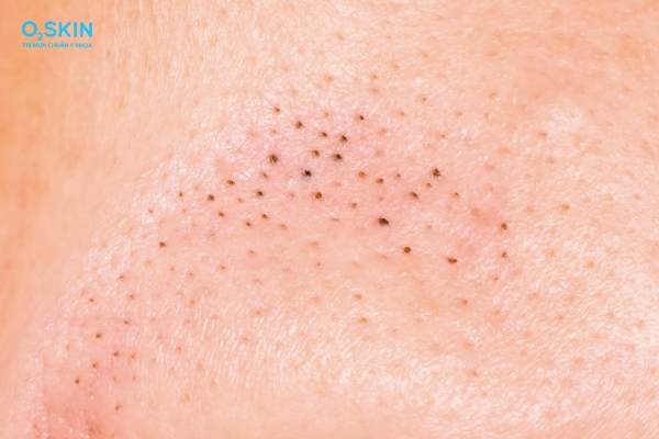 7 Cách Trị Mụn Đầu Đen Tại Nhà Hiệu Quả Từ Bác Sĩ Da Liễu