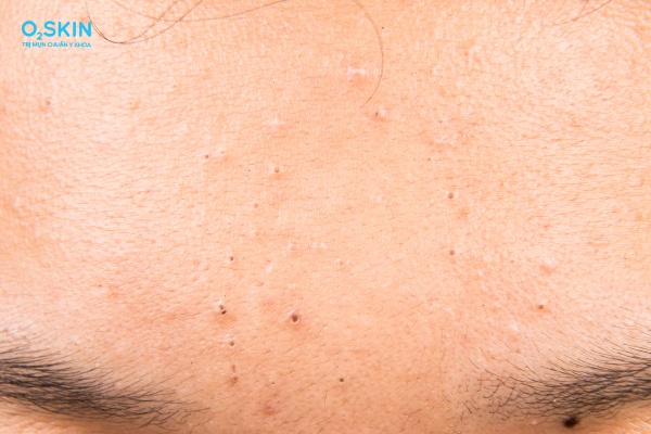 Mụn đầu đen trên trán là gì