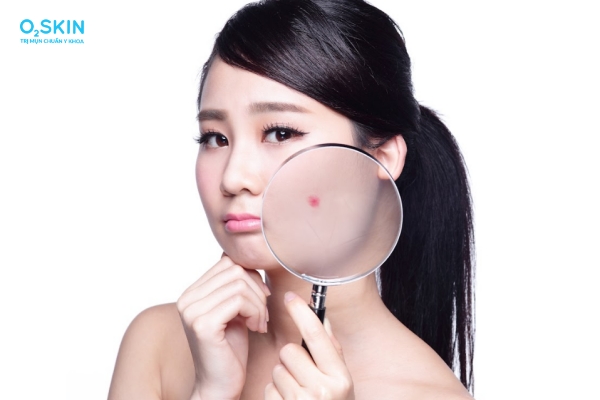 Bao nhiêu tuổi sẽ hết mụn