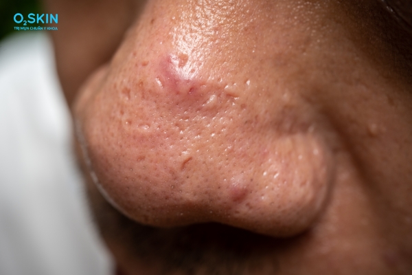 Mọc mụn ở cánh mũi phải