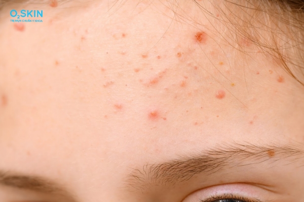 Nặn mụn xong bao lâu thì lành