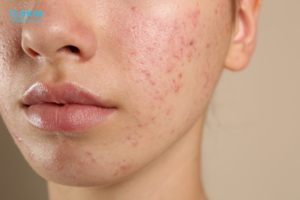 Peel da nổi mụn nước do đâu